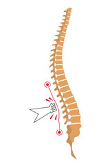 Spinal deformity. Symbol of spine curvatures or unhealthy backbones. Human spine anatomy, curved spine. Diagram with marked section. Body posture defect