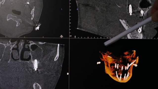 Dental jaw X-ray with teeth and implants. Missing teeth. Dentist uses pen to point at area on image. X-ray radiography. Dentist examines dental arch on computer screen. 4 k video