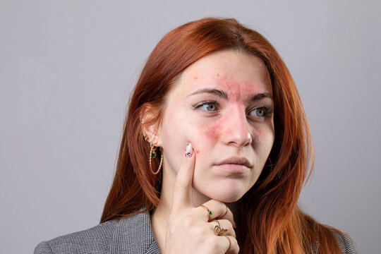 Fair skinned young woman suffering from rosacea. Facial redness due to couperose