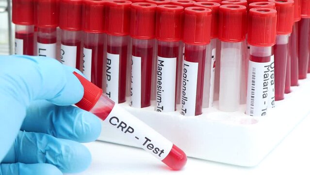 CRP test to look for abnormalities from blood,  blood sample to analyze in the laboratory, blood in test tube
