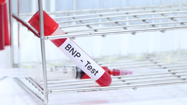 BNP test 