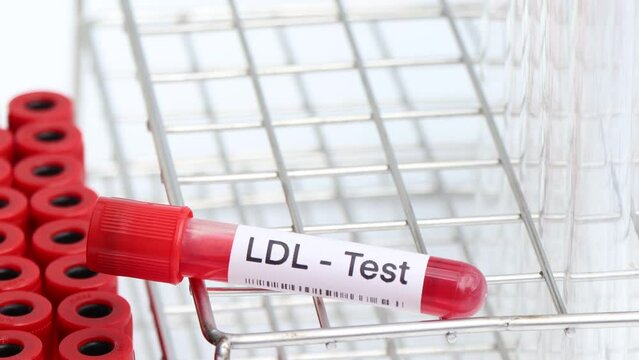 LDL test to look for abnormalities from blood,  blood sample to analyze in the laboratory, blood in test tube