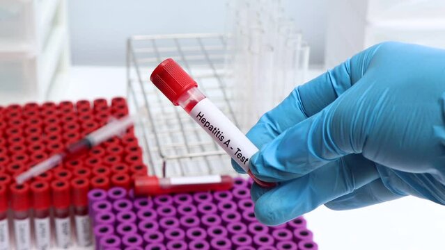 Hepatitis A test to look for abnormalities from blood