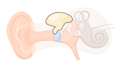 真珠腫性中耳炎のイラスト_上鼓室型真珠腫