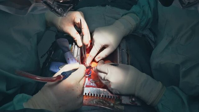 Due to malfunctioning heart valve, open heart surgery is required for during the procedure valve replacement in operating room