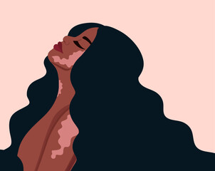 Portrait of a beautiful woman with vitiligo. Self love concept