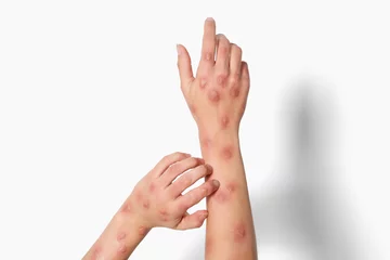 Poster Woman with rash suffering from monkeypox virus on white background, closeup © New Africa
