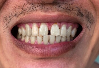 Huge gap between the front teeth or incisors of Asian Chinese man. Diastema.