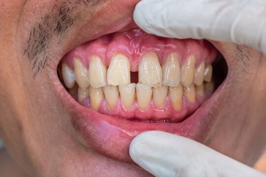 Huge gap between the front teeth or incisors of Asian Chinese man. Diastema. Cracked or chipped teeth.