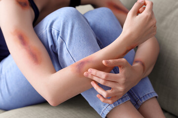 Young woman with bruised arm sitting on sofa at home, closeup