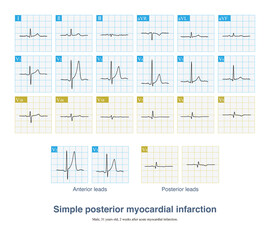 In case of simple posterior myocardial infarction, the amplitude of R wave in lead V2~V3 is increased, and the T wave is tall, which is easy to be misdiagnosed as acute anterior myocardial infarction.