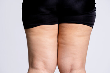 Female legs with cellulite. Skin and body care concept.