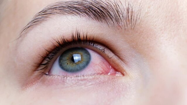Close up of a severe bloodshot red eye. Viral Blepharitis, Conjunctivitis, Adenoviruses. Irritated or infected eye. Corona virus