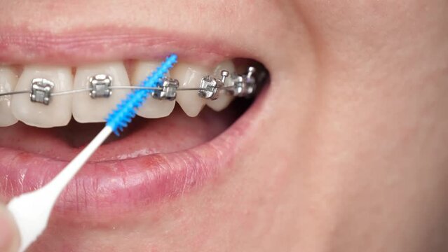 Part of the face. An unknown person is brushing his teeth with a bracket system. Legless braces. oral care while wearing braces. The dream of a beautiful smile.
