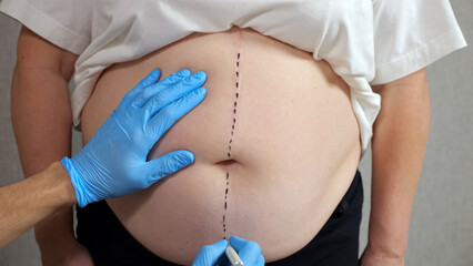 Hand of specialist in rubber glove makes marks on belly of curvy woman on grey background. Female patient prepares for plastic surgery closeup - obrazy, fototapety, plakaty