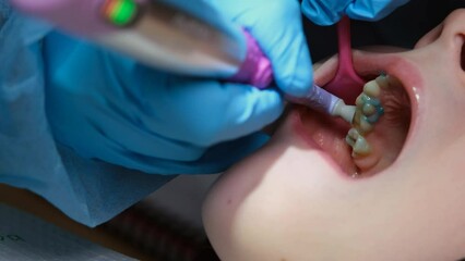 Close up shot of professional scaling kid teeth. Dental hygiene. Teeth tartar and calculus deep cleaning. Professional teeth cleaning. Teeth treatment in child dental cabinet. Work Dentist. Healthcare