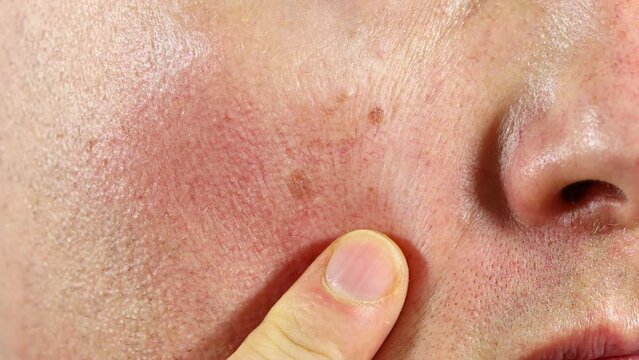 Red face, broken capillaries, health problems, sensitive skin