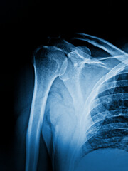 Naklejka premium Film x-ray both clavicle AP 