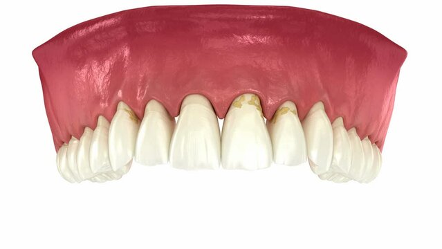 Periodontitis and gum recession in dynamics, teeth losing. Dental 3D animation