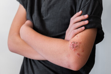 teenager scratching his hand with allergic lesions on the skin.skin of the hands with red wounds of diathesis and dermatitis from allergies and stress close-up