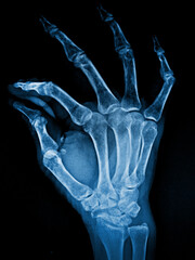 X-ray adult's hand bone 