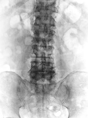 X-ray of the  spinal column