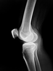 Osteoarthritis both knee . film x-ray AP