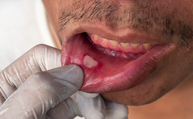 Aphthous ulcer, canker sore or stress ulcer in the mouth of Asian male patient.