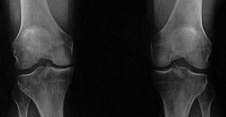x ray image of knee - obrazy, fototapety, plakaty