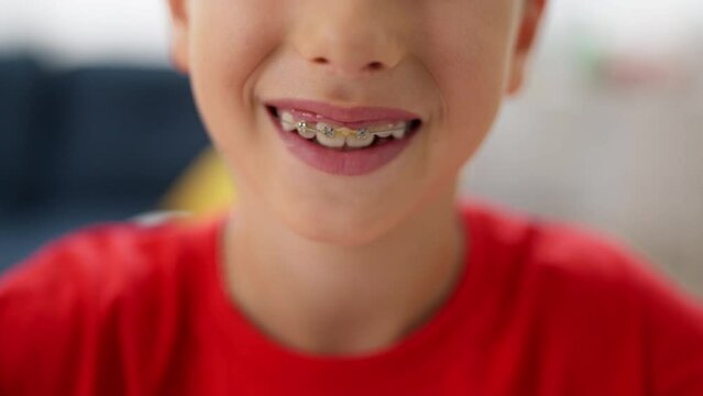 Closeup of boy wearing braces, orthodontic treatment, teeth straightening