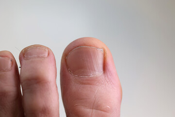 Palec człowieka z czarnym paznokciem - krwiak pod paznokciem. 