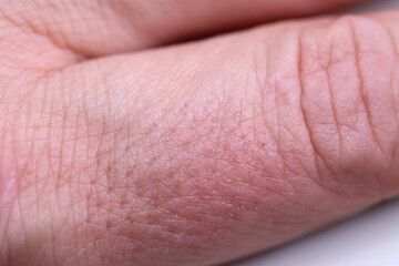 Palec człowieka z czarnym paznokciem - krwiak pod paznokciem. 