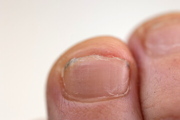 Palec człowieka z czarnym paznokciem - krwiak pod paznokciem. 
