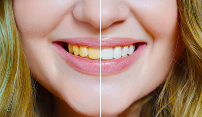 close-up. a woman's smile with a comparison of whitened and yellow teeth. 