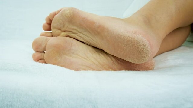 Dry skin of female feet. Selective focus.