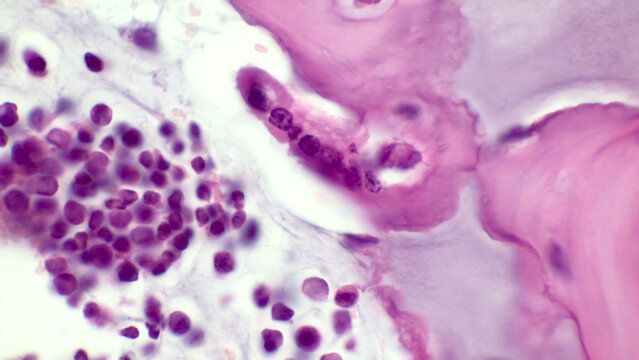Osteoclast. Light micrograph of an osteoclast displaying typical distinguishing characteristics: a large cell with multiple nuclei. Haematoxylin end eosin stain.