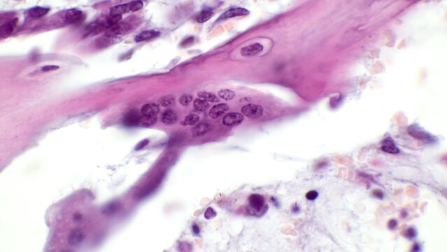 Osteoclast. Light micrograph of an osteoclast displaying typical distinguishing characteristics: a large cell with multiple nuclei. Zoledronic acid inhibits osteoclast differentiation. 
