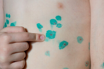 Infectious disease chicken pox in children, boy showing bumpy abdomen