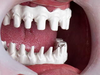 emax crowns on hybrid bridge on implants
