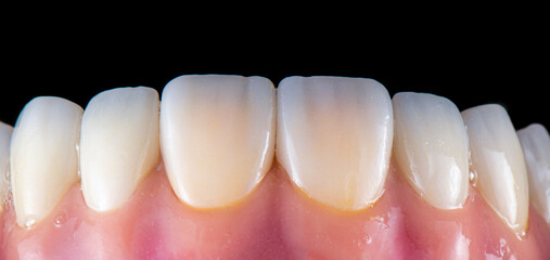 emax crowns on hybrid bridge on implants