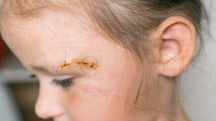 Close up sad, brave, drear cropped girl face with stitches on scratch of eyebrow dissection,...