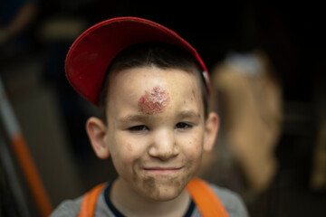 Child with lump on his forehead. Wound on boy's head. Schoolboy in scratches. Portrait of hooligan....