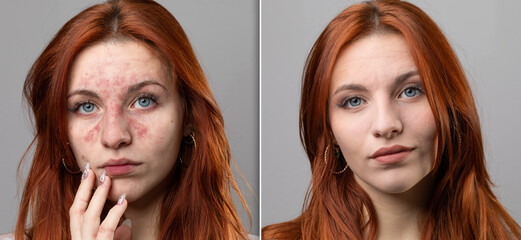 Before and after of a successful laser rosacea removal treatment