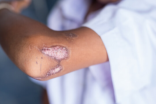 close up photo of fire burn wound from hard accident in daily life activity. soft focus.