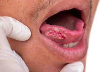 Squamous cell carcinoma of tongue. Oral cancer or malignant tumor of Asian male patient. - obrazy, fototapety, plakaty