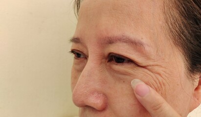 Portrait showing the flabbiness and wrinkle, ptosis and flabby skin beside the eyelid, Wrinkled and...