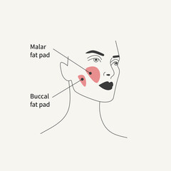 Removal of malar fat pad and buccal fat pad