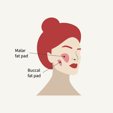 Removal of malar fat pad and buccal fat pad