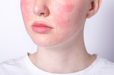 rosacea couperose redness skin, red spots on cheeks, young woman with sensitive skin, patient face close-up  - obrazy, fototapety, plakaty