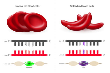 Sickle cell disease. Normal red blood cells and sickled red blood cells. Point mutation. 